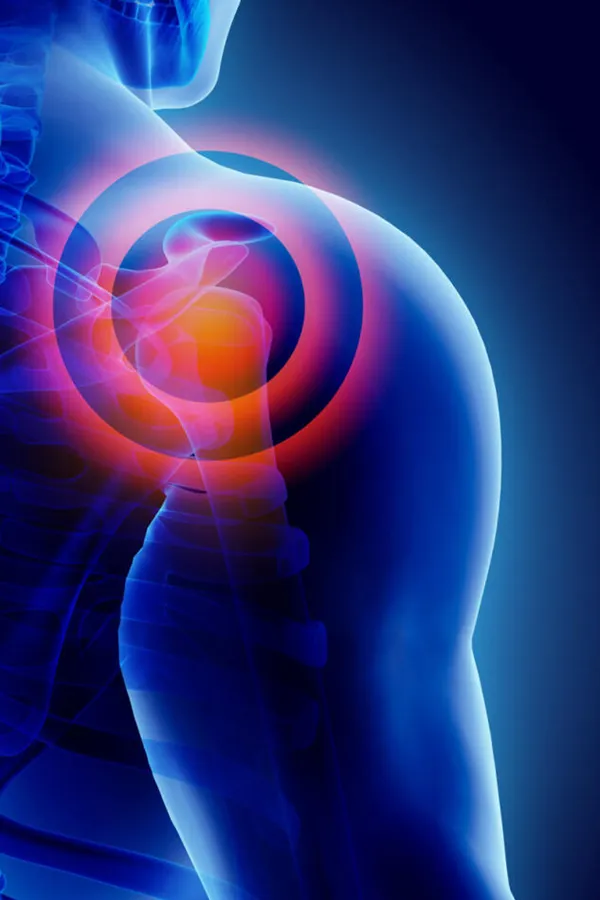 Exosomes-for-Shoulder-Pain-Treatment 3D illustration of shoulder inflammation. Get exosome therapy for shoulder pain from David Garcia, D.O. in Nashville Metro.